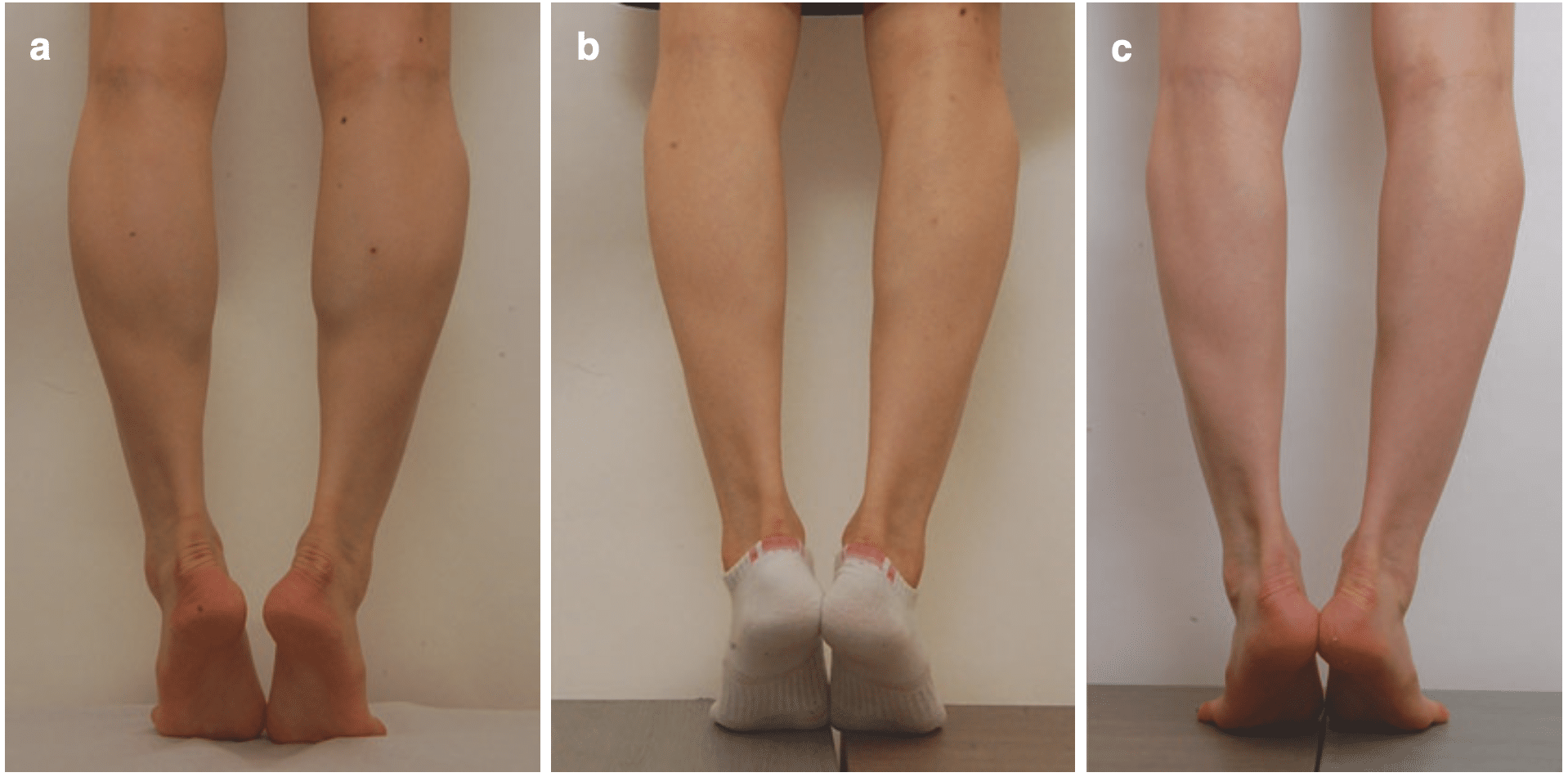 你知道小腿肉毒其實要分兩階段嗎？兩階段大幅延長美腿時間